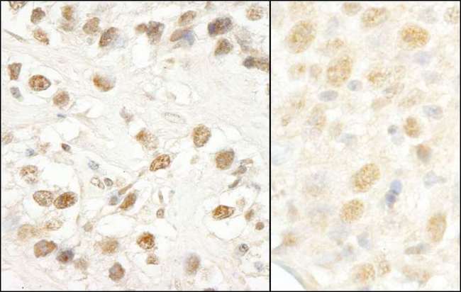 LUC7L3 / CROP Antibody - Detection of Human and Mouse CROP/Luc7A by Immunohistochemistry. Sample: FFPE section of human testicular seminoma (left) and mouse colon carcinoma (right). Antibody: Affinity purified rabbit anti-CROP/Luc7A used at a dilution of 1:1000 (1 ug/ml). Detection: DAB.