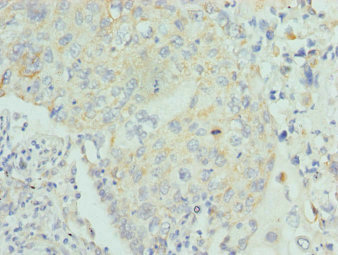 Lumican Antibody - Immunohistochemistry of paraffin-embedded human lung cancer tissue at dilution 1:100