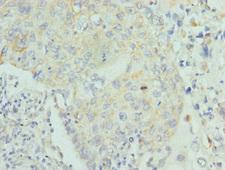 Lumican Antibody - Immunohistochemistry of paraffin-embedded human lung cancer tissue at dilution 1:100
