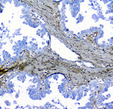Lumican Antibody - IHC analysis of Lumican using anti-Lumican antibody. Lumican was detected in paraffin-embedded section of human ovary cancer tissue. Heat mediated antigen retrieval was performed in citrate buffer (pH6, epitope retrieval solution) for 20 mins. The tissue section was blocked with 10% goat serum. The tissue section was then incubated with 1µg/ml rabbit anti-Lumican Antibody overnight at 4°C. Biotinylated goat anti-rabbit IgG was used as secondary antibody and incubated for 30 minutes at 37°C. The tissue section was developed using Strepavidin-Biotin-Complex (SABC) with DAB as the chromogen.