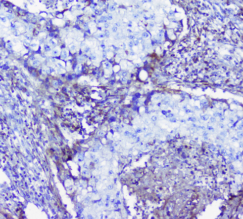 Lumican Antibody - IHC analysis of Lumican using anti-Lumican antibody. Lumican was detected in paraffin-embedded section of human lung cancer tissue. Heat mediated antigen retrieval was performed in citrate buffer (pH6, epitope retrieval solution) for 20 mins. The tissue section was blocked with 10% goat serum. The tissue section was then incubated with 1µg/ml rabbit anti-Lumican Antibody overnight at 4°C. Biotinylated goat anti-rabbit IgG was used as secondary antibody and incubated for 30 minutes at 37°C. The tissue section was developed using Strepavidin-Biotin-Complex (SABC) with DAB as the chromogen.