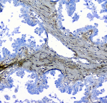 Lumican Antibody - IHC staining of FFPE human ovarian cancer with LUM antibody at 1ug/ml. HIER: boil tissue sections in pH6, 10mM citrate buffer, for 10-20 min followed by cooling at RT for 20 min.