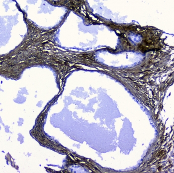 Lumican Antibody - IHC staining of FFPE human pancreatic cancer with LUM antibody at 1ug/ml. HIER: boil tissue sections in pH6, 10mM citrate buffer, for 10-20 min followed by cooling at RT for 20 min.