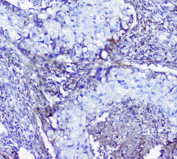 Lumican Antibody - IHC staining of FFPE human lung cancer with LUM antibody at 1ug/ml. HIER: boil tissue sections in pH6, 10mM citrate buffer, for 10-20 min followed by cooling at RT for 20 min.