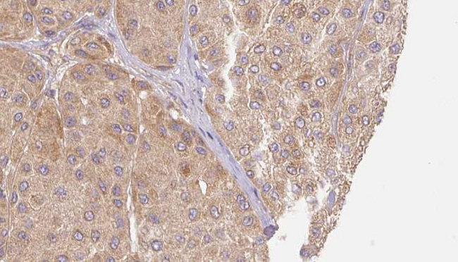 Lumican Antibody - 1:100 staining human Melanoma tissue by IHC-P. The sample was formaldehyde fixed and a heat mediated antigen retrieval step in citrate buffer was performed. The sample was then blocked and incubated with the antibody for 1.5 hours at 22°C. An HRP conjugated goat anti-rabbit antibody was used as the secondary.