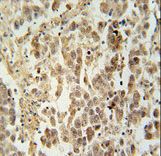 LUZP4 Antibody - LUZP4 antibody immunohistochemistry of formalin-fixed and paraffin-embedded human testis carcinoma followed by peroxidase-conjugated secondary antibody and DAB staining.