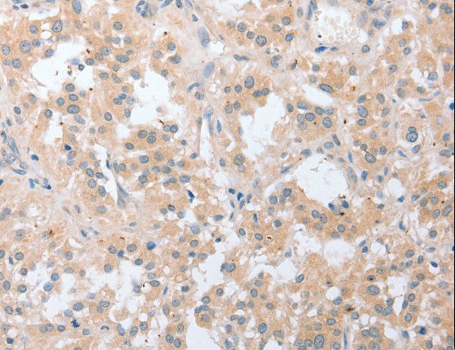 LY96 / MD2 / MD-2 Antibody - Immunohistochemistry of paraffin-embedded Human thyroid cancer using LY96 Polyclonal Antibody at dilution of 1:20.