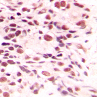 LYAR Antibody - Immunohistochemical analysis of LYAR staining in human breast cancer formalin fixed paraffin embedded tissue section. The section was pre-treated using heat mediated antigen retrieval with sodium citrate buffer (pH 6.0). The section was then incubated with the antibody at room temperature and detected using an HRP conjugated compact polymer system. DAB was used as the chromogen. The section was then counterstained with hematoxylin and mounted with DPX.