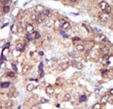 LYN Antibody - Formalin-fixed and paraffin-embedded human cancer tissue reacted with the primary antibody, which was peroxidase-conjugated to the secondary antibody, followed by AEC staining. This data demonstrates the use of this antibody for immunohistochemistry; clinical relevance has not been evaluated. BC = breast carcinoma; HC = hepatocarcinoma.