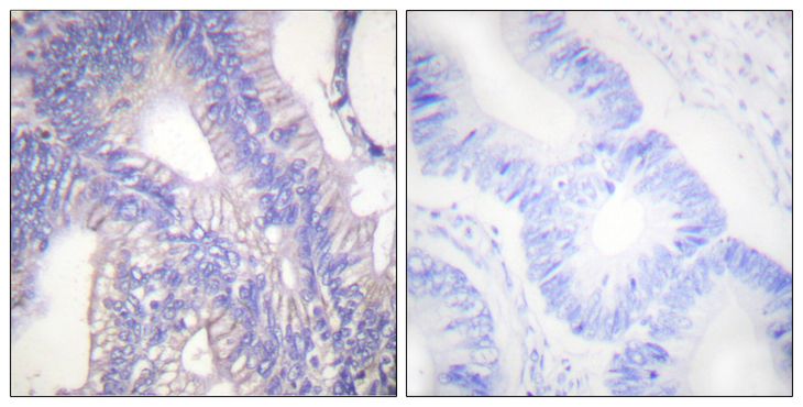 LYN Antibody - Immunohistochemistry analysis of paraffin-embedded human colon carcinoma tissue, using Lyn Antibody. The picture on the right is blocked with the synthesized peptide.