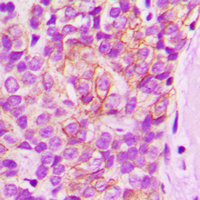 LYN Antibody - Immunohistochemical analysis of LYN (pY397) staining in human breast cancer formalin fixed paraffin embedded tissue section. The section was pre-treated using heat mediated antigen retrieval with sodium citrate buffer (pH 6.0). The section was then incubated with the antibody at room temperature and detected using an HRP conjugated compact polymer system. DAB was used as the chromogen. The section was then counterstained with hematoxylin and mounted with DPX.