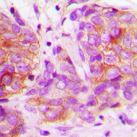 LYN Antibody - Immunohistochemical analysis of LYN staining in human breast cancer formalin fixed paraffin embedded tissue section. The section was pre-treated using heat mediated antigen retrieval with sodium citrate buffer (pH 6.0). The section was then incubated with the antibody at room temperature and detected using an HRP conjugated compact polymer system. DAB was used as the chromogen. The section was then counterstained with hematoxylin and mounted with DPX.