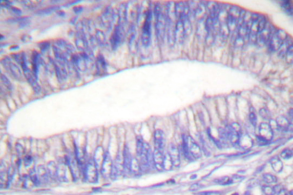 LYN Antibody - IHC of Lyn (T501) pAb in paraffin-embedded human colon carcinoma tissue.