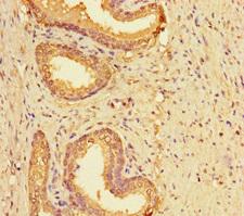 LYPD2 Antibody - Immunohistochemistry of paraffin-embedded human prostate cancer using LYPD2 Antibody at dilution of 1:100