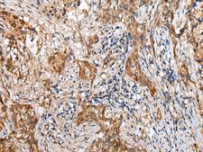 LYPD4 Antibody - Immunohistochemistry of paraffin-embedded Human lung cancer tissue  using LYPD4 Polyclonal Antibody at dilution of 1:25(×200)