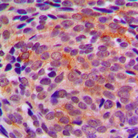 LYPLA1 Antibody - Immunohistochemical analysis of LYPLA1 staining in human breast cancer formalin fixed paraffin embedded tissue section. The section was pre-treated using heat mediated antigen retrieval with sodium citrate buffer (pH 6.0). The section was then incubated with the antibody at room temperature and detected using an HRP conjugated compact polymer system. DAB was used as the chromogen. The section was then counterstained with hematoxylin and mounted with DPX.