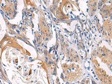 LYPLA1 Antibody - Immunohistochemistry of paraffin-embedded Human esophagus cancer tissue  using LYPLA1 Polyclonal Antibody at dilution of 1:45(×200)