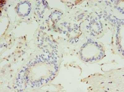 LYPLAL1 Antibody - Immunohistochemistry of paraffin-embedded human breast cancer using antibody at dilution of 1:100.