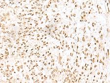 LYRM1 Antibody - Immunohistochemistry of paraffin-embedded Human liver cancer tissue  using LYRM1 Polyclonal Antibody at dilution of 1:50(×200)