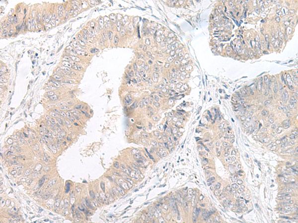 LYRM2 Antibody - Immunohistochemistry of paraffin-embedded Human colorectal cancer tissue  using LYRM2 Polyclonal Antibody at dilution of 1:50(×200)
