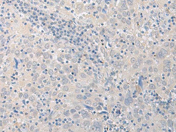 LYRM2 Antibody - Immunohistochemistry of paraffin-embedded Human cervical cancer tissue  using LYRM2 Polyclonal Antibody at dilution of 1:50(×200)