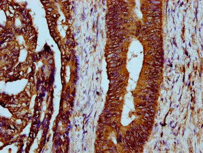 LYRM4 Antibody - Immunohistochemistry Dilution at 1:300 and staining in paraffin-embedded human colon cancer performed on a Leica BondTM system. After dewaxing and hydration, antigen retrieval was mediated by high pressure in a citrate buffer (pH 6.0). Section was blocked with 10% normal Goat serum 30min at RT. Then primary antibody (1% BSA) was incubated at 4°C overnight. The primary is detected by a biotinylated Secondary antibody and visualized using an HRP conjugated SP system.
