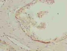 LYSMD1 Antibody - Immunohistochemistry of paraffin-embedded human prostate cancer using antibody at dilution of 1:100.