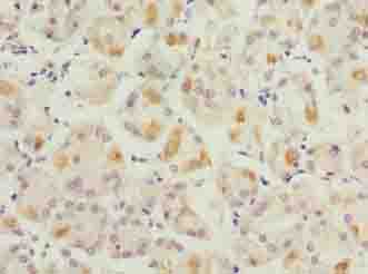 LYSMD1 Antibody - Immunohistochemistry of paraffin-embedded human gastric cancer using antibody at dilution of 1:100.