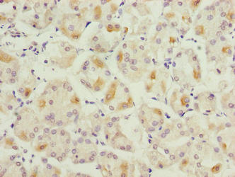 LYSMD1 Antibody - Immunohistochemistry of paraffin-embedded human gastric cancer using LYSMD1 Antibody at dilution of 1:100