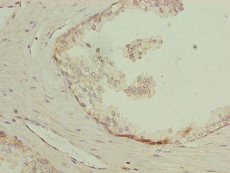LYSMD1 Antibody - Immunohistochemistry of paraffin-embedded human prostate cancer using LYSMD1 Antibody at dilution of 1:100