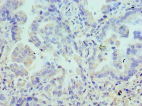 LYVE1 Antibody - Immunohistochemistry of paraffin-embedded human lung cancer using antibody at 1:100 dilution.