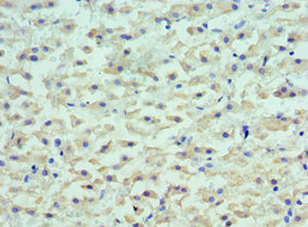 LYVE1 Antibody - Immunohistochemistry of paraffin-embedded human liver cancer using LYVE1 Antibody at dilution of 1:100