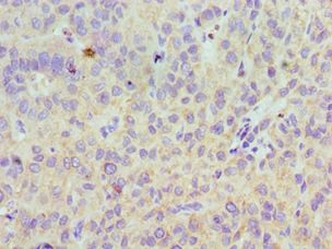 LYVE1 Antibody - Immunohistochemistry of paraffin-embedded human liver cancer using antibody at 1:100 dilution.