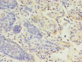 LYZ / Lysozyme Antibody - Immunohistochemistry of paraffin-embedded human gastric cancer using antibody at 1:100 dilution.  This image was taken for the unconjugated form of this product. Other forms have not been tested.