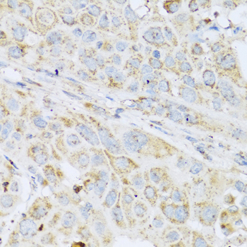 LYZ / Lysozyme Antibody - Immunohistochemistry of paraffin-embedded mouse esophageal cancer tissue.