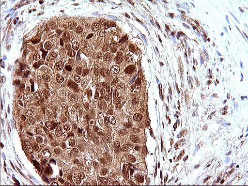 LZIC Antibody - IHC of paraffin-embedded Carcinoma of Human prostate tissue using anti-LZIC mouse monoclonal antibody. (Heat-induced epitope retrieval by 10mM citric buffer, pH6.0, 120°C for 3min).