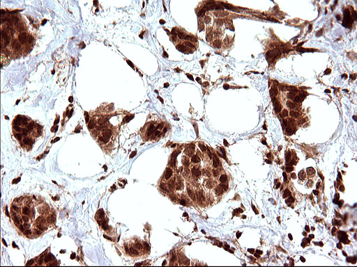 LZIC Antibody - IHC of paraffin-embedded Adenocarcinoma of Human breast tissue using anti-LZIC mouse monoclonal antibody. (Heat-induced epitope retrieval by 10mM citric buffer, pH6.0, 120°C for 3min).