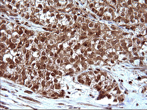 LZIC Antibody - IHC of paraffin-embedded Carcinoma of Human liver tissue using anti-LZIC mouse monoclonal antibody. (Heat-induced epitope retrieval by 10mM citric buffer, pH6.0, 120°C for 3min).
