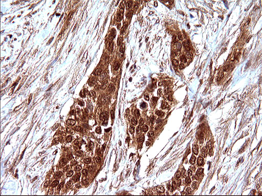 LZIC Antibody - IHC of paraffin-embedded Carcinoma of Human bladder tissue using anti-LZIC mouse monoclonal antibody. (Heat-induced epitope retrieval by 10mM citric buffer, pH6.0, 120°C for 3min).