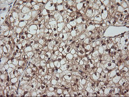 LZIC Antibody - IHC of paraffin-embedded Carcinoma of Human kidney tissue using anti-LZIC mouse monoclonal antibody.