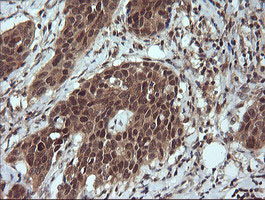 LZIC Antibody - IHC of paraffin-embedded Carcinoma of Human bladder tissue using anti-LZIC mouse monoclonal antibody.