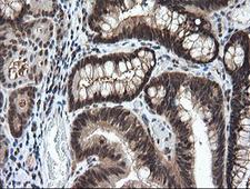 LZIC Antibody - IHC of paraffin-embedded Adenocarcinoma of Human colon tissue using anti-LZIC mouse monoclonal antibody.