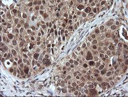 LZIC Antibody - IHC of paraffin-embedded Carcinoma of Human lung tissue using anti-LZIC mouse monoclonal antibody.