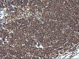 LZIC Antibody - IHC of paraffin-embedded Human lymphoma tissue using anti-LZIC mouse monoclonal antibody.