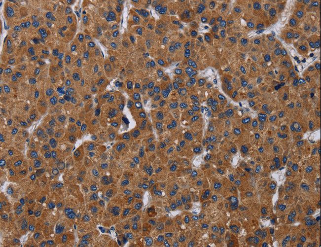 LZTFL1 Antibody - Immunohistochemistry of paraffin-embedded Human liver cancer using LZTFL1 Polyclonal Antibody at dilution of 1:30.