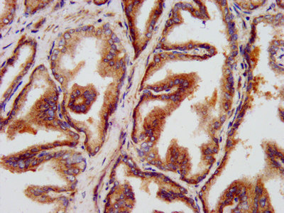 LZTS1 Antibody - Immunohistochemistry image at a dilution of 1:500 and staining in paraffin-embedded human prostate tissue performed on a Leica BondTM system. After dewaxing and hydration, antigen retrieval was mediated by high pressure in a citrate buffer (pH 6.0) . Section was blocked with 10% normal goat serum 30min at RT. Then primary antibody (1% BSA) was incubated at 4 °C overnight. The primary is detected by a biotinylated secondary antibody and visualized using an HRP conjugated SP system.