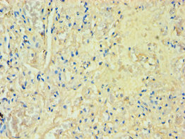 M-PST / STM Antibody - Immunohistochemistry of paraffin-embedded human lung tissue using Rabbit anti-human Sulfotransferase 1A3 polyclonal Antibody(SULT1A3) at dilution of 1:100