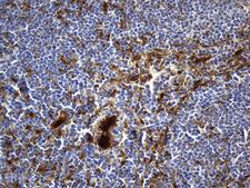 M-PST / STM Antibody - Immunohistochemical staining of paraffin-embedded Human lymphoma tissue using anti-SULT1A3 mouse monoclonal antibody. (Heat-induced epitope retrieval by 1mM EDTA in 10mM Tris buffer. (pH8.5) at 120°C for 3 min. (1:500)