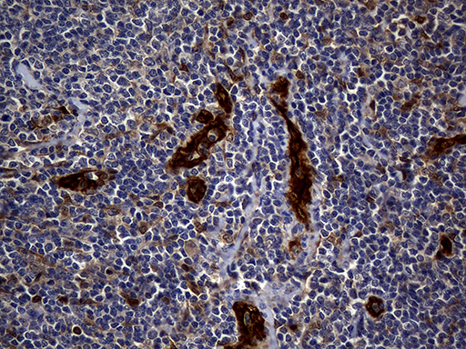 M-PST / STM Antibody - Immunohistochemical staining of paraffin-embedded Human lymphoma tissue using anti-SULT1A3 mouse monoclonal antibody. (Heat-induced epitope retrieval by 1mM EDTA in 10mM Tris buffer. (pH8.5) at 120°C for 3 min. (1:150)