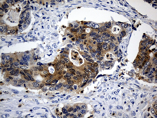M-PST / STM Antibody - Immunohistochemical staining of paraffin-embedded Adenocarcinoma of Human colon tissue using anti-SULT1A3 mouse monoclonal antibody. (Heat-induced epitope retrieval by 1mM EDTA in 10mM Tris buffer. (pH8.5) at 120°C for 3 min. (1:500)